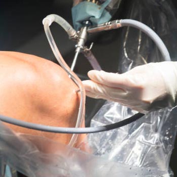Arthroscopy