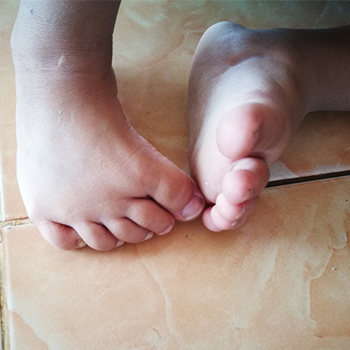 deformity correction